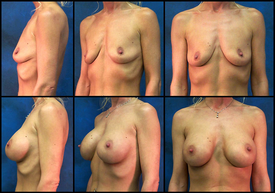breast augment image 1