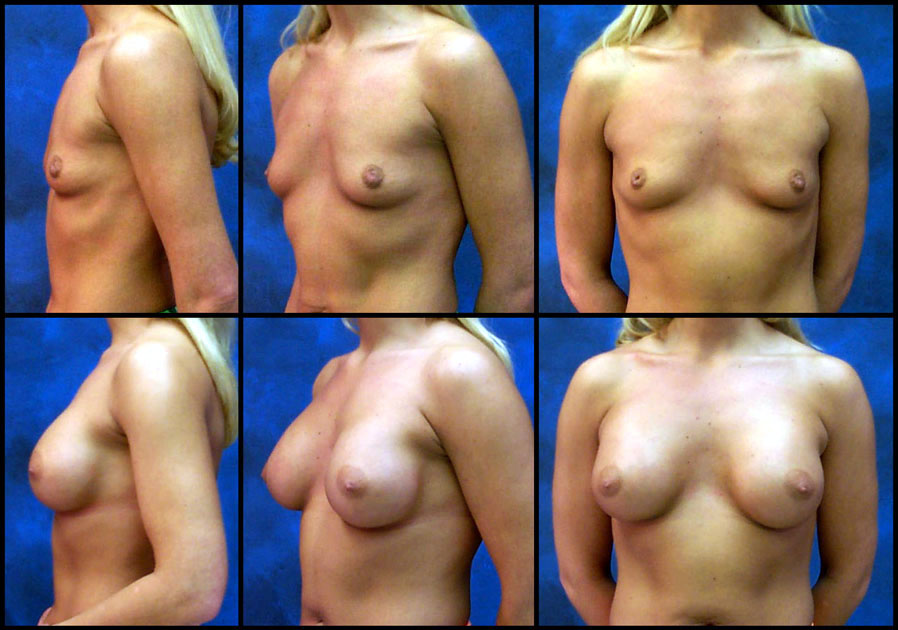 breast augment image 2