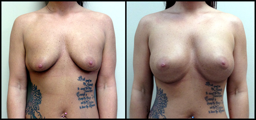 breast augment image 3
