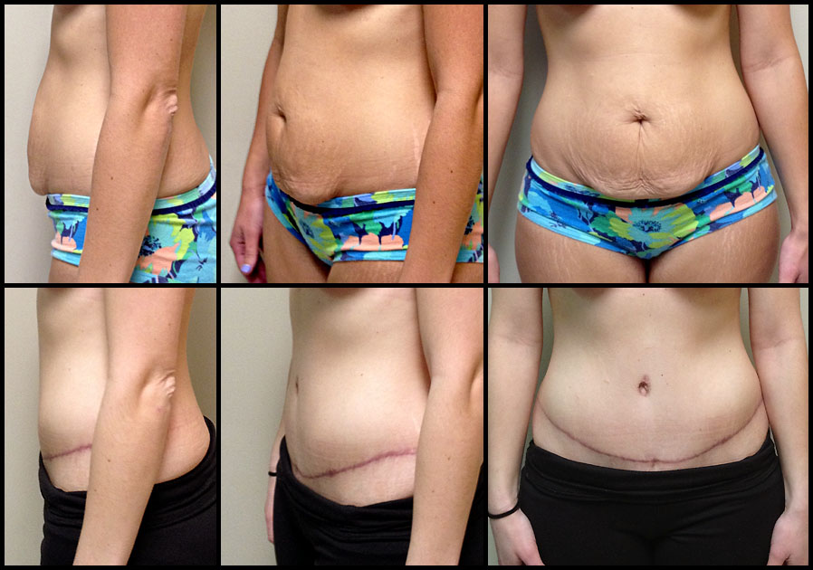 abdominoplasty image 1