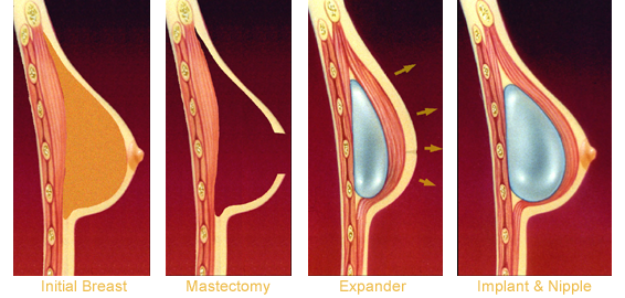 tissue expander diagram