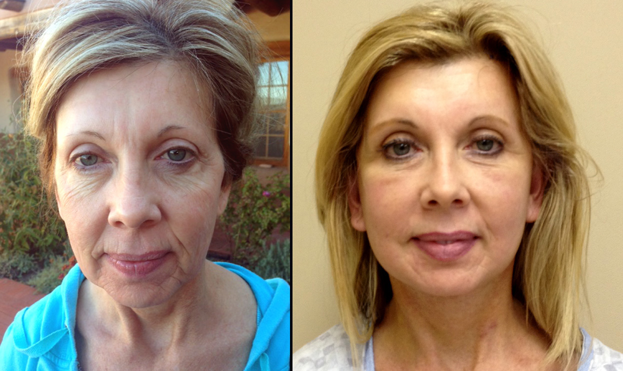 facelift image 1