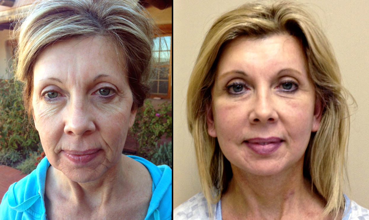 facelift image 1