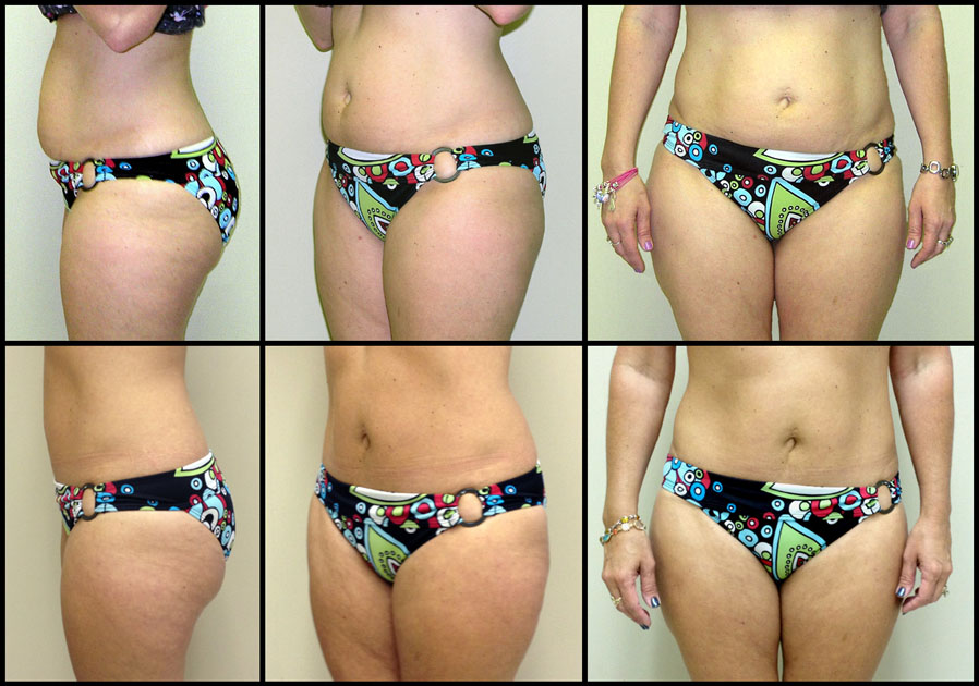 mini abdominoplasty image 1