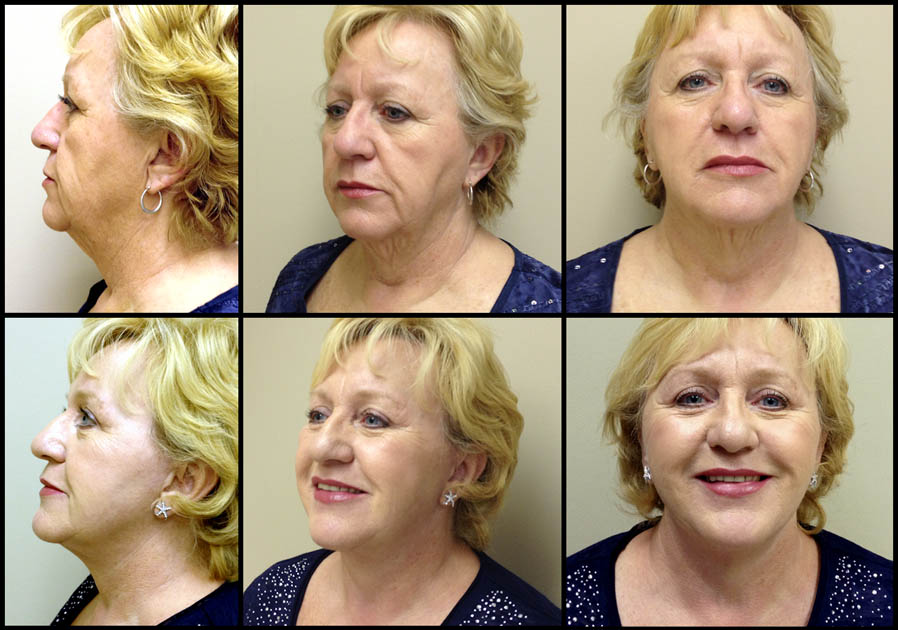 necklift image 1