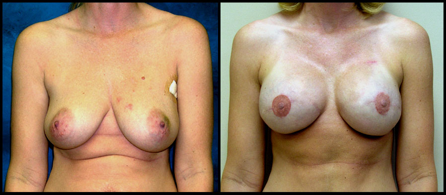 breast reconstruction image 3