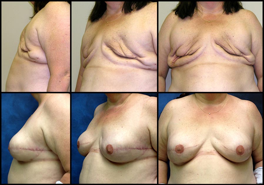 breast reconstruction image 4