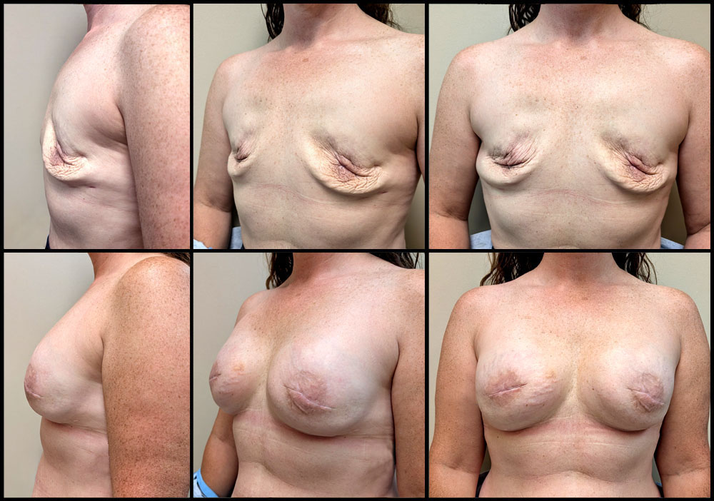 breast reconstruction image 6