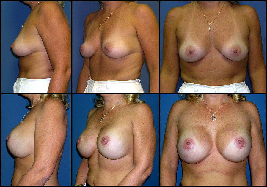 breast reconstruction image 1